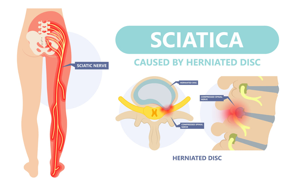 TENS Unit for Sciatica Pain - Tensunits Pain Relief